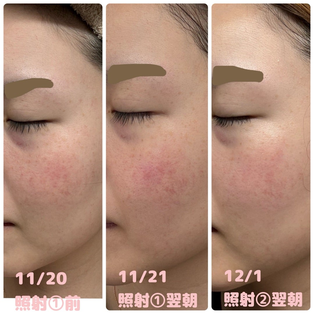 レビュー】☆5 キレイモ脱毛器で自宅フォトフェイシャル | アトピー