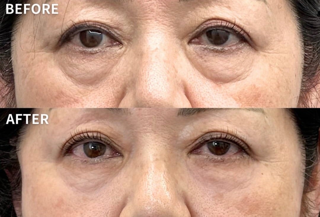 レーザーで青グマ改善✨目の下のたるみ、クマ、色ぐまは「フォトナアイ