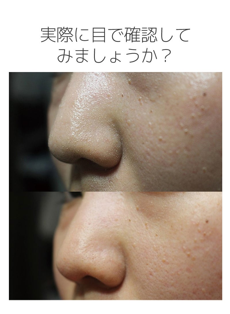 角栓・黒ずみ！毛穴をすっきりケア！リアルなアクアピーリング機で確実