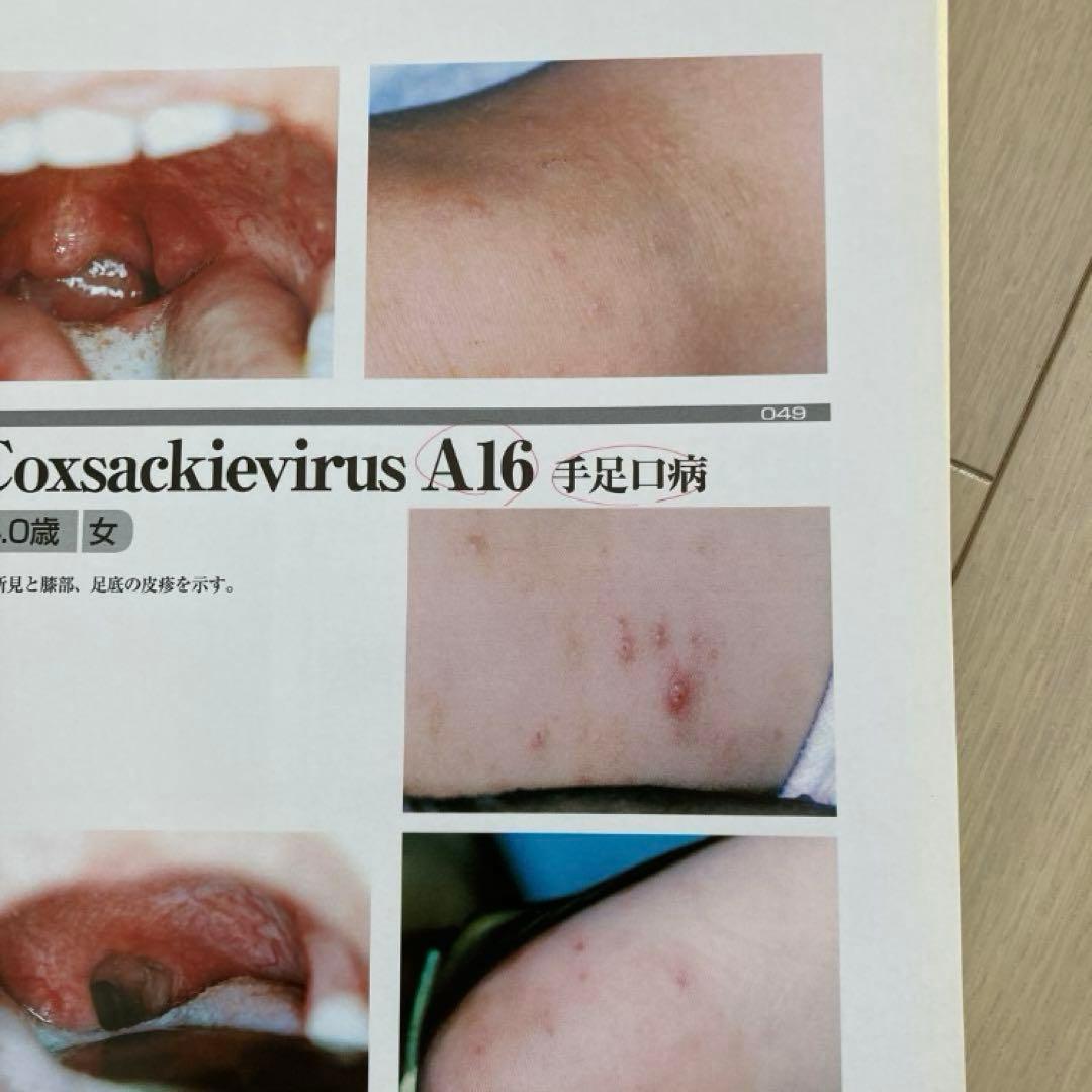 アトラスさくま 小児咽頭所見 フルカラーオリジナル症例写真284点